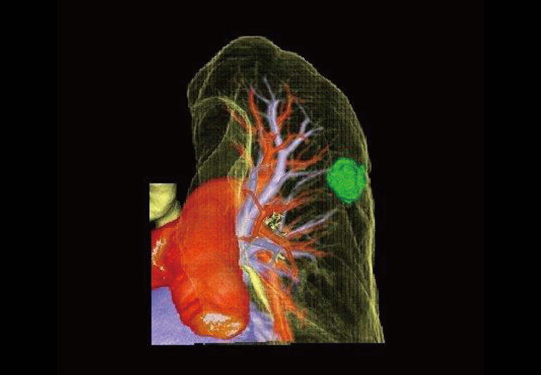 CT（コンピュータ断層撮影）の３−D画像。緑色の部分ががん細胞