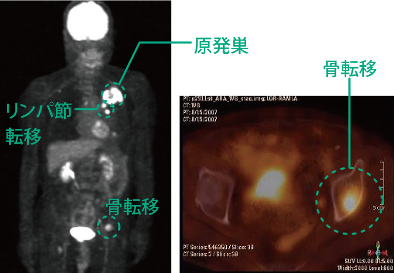 PET（陽電子放射断層撮影法）。がん細胞に集まる薬剤（FDG）を注射し、放射線を利用して画像化。リンパ節転移や遠隔転移の診断に有用