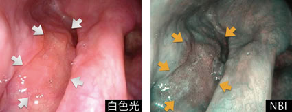 この内視鏡システムの開発には、恵佑会札幌病院の豊富な臨床経験が生かされています。今後はさらに精度を上げて世界へも発信し、頭頸部がんの早期発見につなげていきたいと願っています。